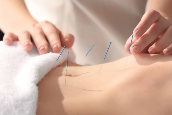Acupunctura, remediu pentru constipația severă