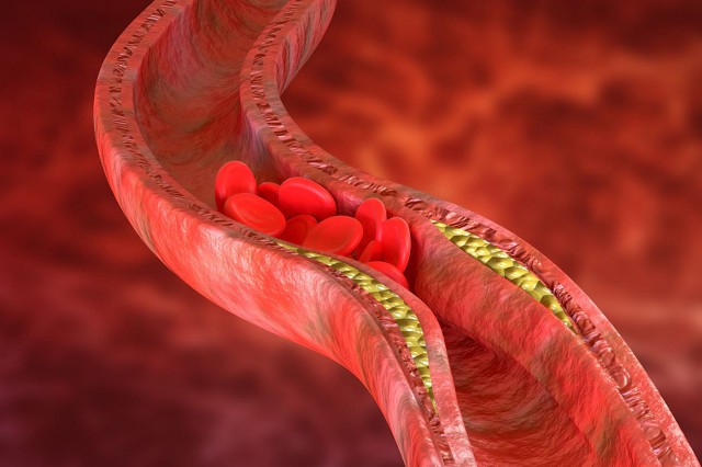 Studiu: Ateroscleroza, prevenită cu ajutorul unor peptide?