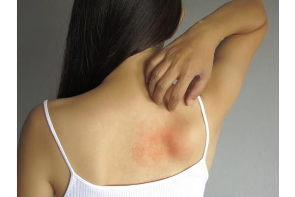 Dermatita de contact: Cauze - Simptome - Tratament