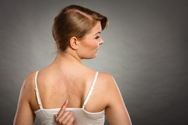 Urticaria: cauze, simptome și tratament