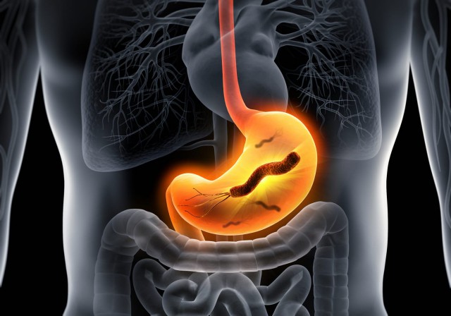 Helicobacter Pylori - Cauze, simptome și tratament