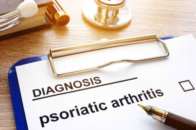 Cum gestionezi episoadele acute de artrită psoriazică?