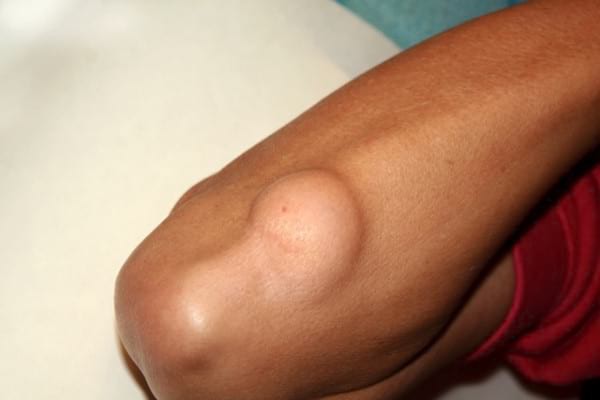 Totul despre lipoame - localizare, cauze, tratament