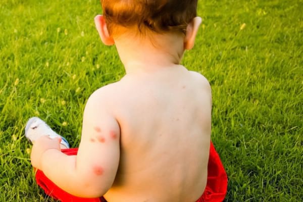 Remedii pentru înțepăturile de insecte