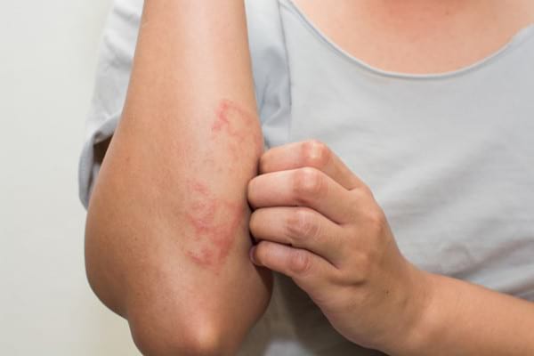 10 remedii naturale pentru psoriazis