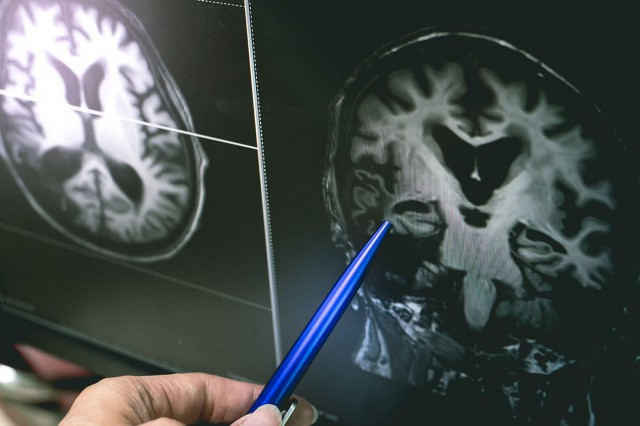 Boala Alzheimer: ce diferențe apar în creierul bolnavilor?