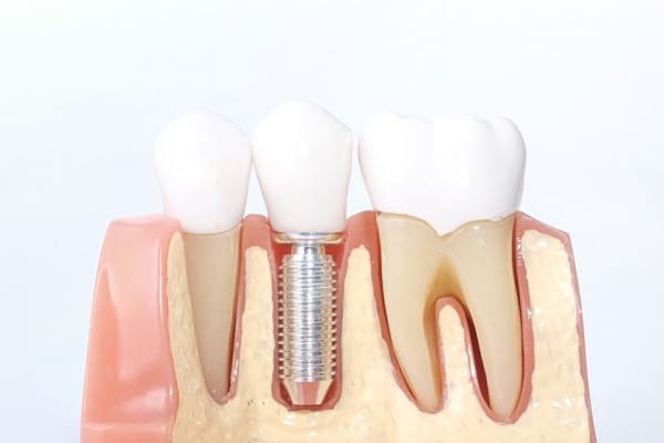 Ce avantaje are implantul dentar realizat în totalitate din ceramică