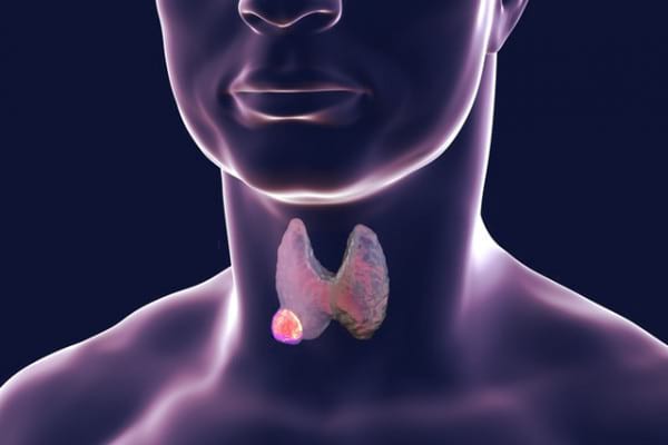 Neoplasmele tiroidiene sau nodulii tiroidieni: cauze, simptome, tratament