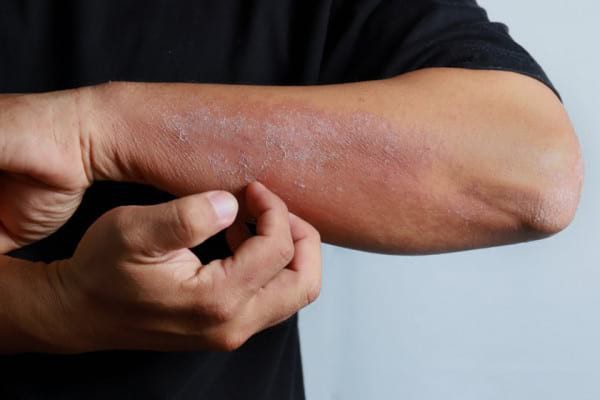 Alimentația în dermatita atopică: ce este recomandat și ce nu?