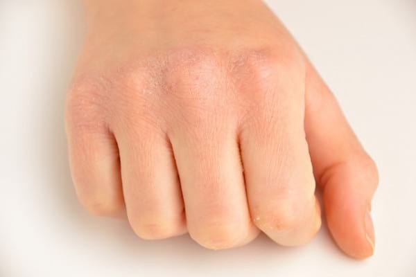 Pielea foarte uscată – factor de risc pentru cancerul de piele?