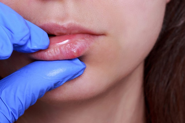 Cancerul la buze: cauze, simptome, tratament