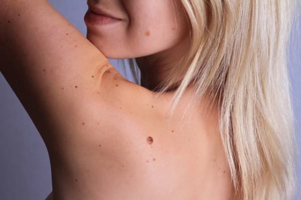 Cât de des ne autoexaminăm alunițele și cât de des mergem la dermatolog?