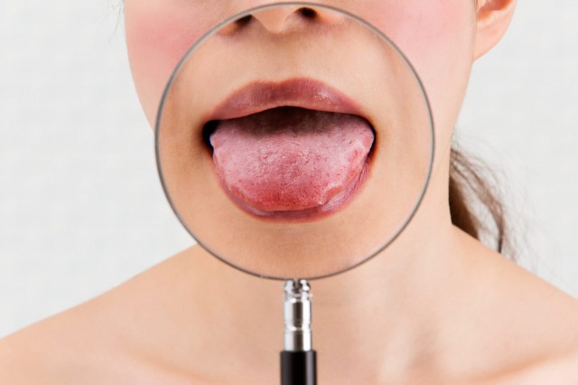 Primele simptome ale cancerului oral