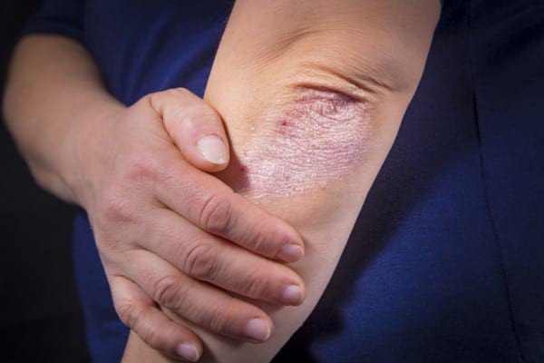 Dieta în psoriazis: cum reduci inflamația din organism?