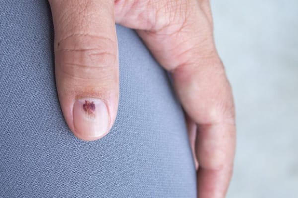 Alunițele sub unghie – factor de risc pentru melanom?