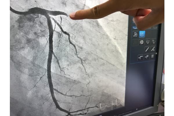 Angiografia coronariană: ce este, cum se efectuează, când este indicată