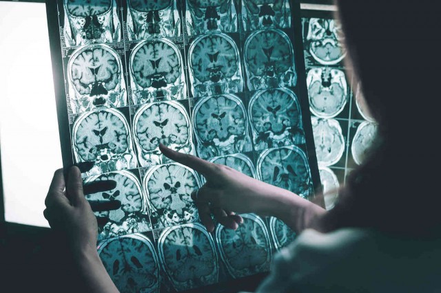 Boala Alzheimer: care sunt cele patru subtipuri?
