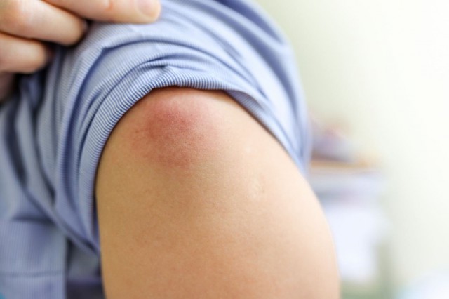Celulita infecțioasă: ce este, tratament, prevenire