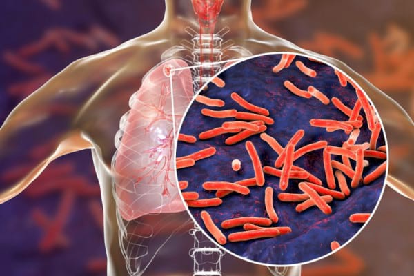 Tuberculoza (TBC) - Ce este, Simptome și Tratament