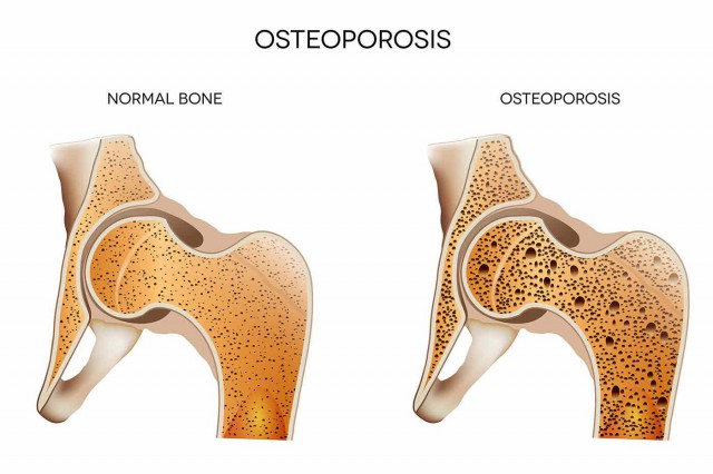 Studiu: Osteoporoza crește riscul de boli de inimă la femei