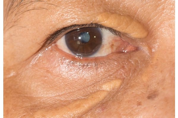 Xantoamele: cauze și diagnostic