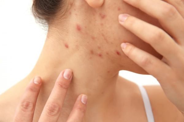 Alimente care îți agravează acneea