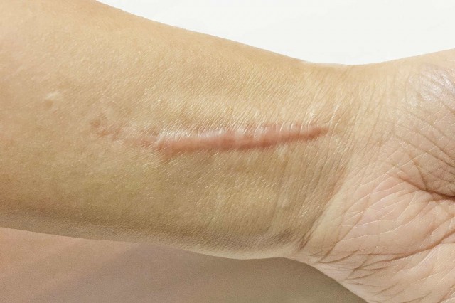 Cicatrici - tipuri, tratament și prevenție