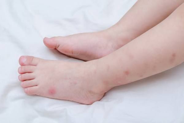 5 tipuri de mușcături de insecte pe care nu trebuie să le ignori