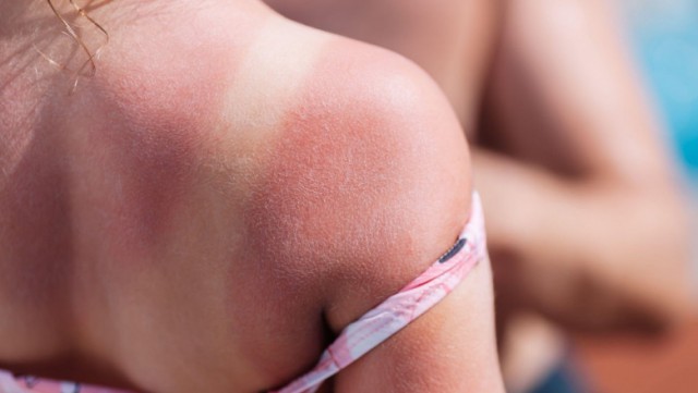 Cum arată pielea după expunerea la soare. Medic: La cinci arsuri solare grave, riscul de cancer crește la 75%
