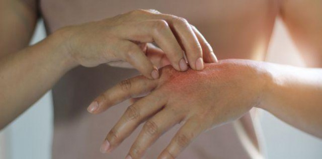 Studiu: Lipsa mișcării predispune la psoriazis?
