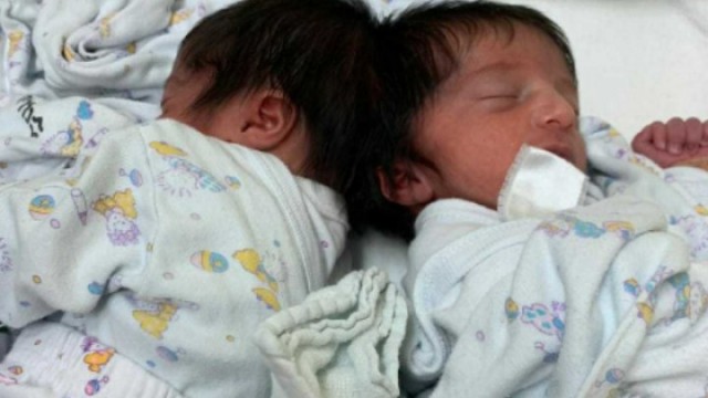 Operație RARĂ Israel: Două fetițe siameze unite în zona cefei au fost separate cu succes