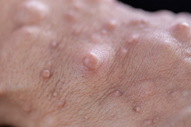 Neurofibromatoza sau boala petelor “café-o-lait”