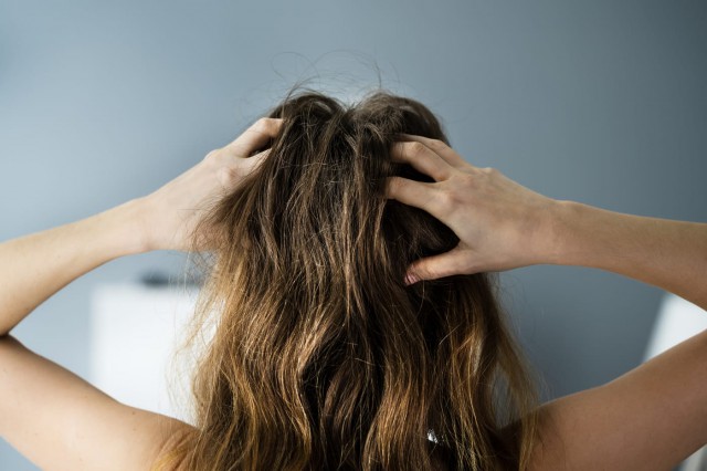 Psoriazisul scalpului versus mătreață: care sunt diferențele și cum ameliorăm mâncărimile