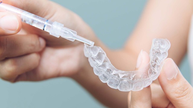 Ce efect are albirea dinților asupra smalțului dentar?