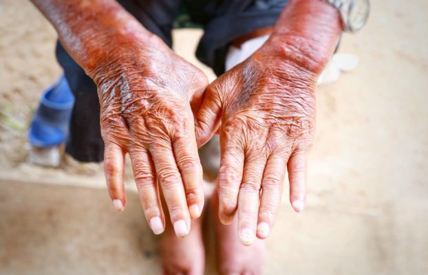 Sclerodermia: simptome, cauze, tratament