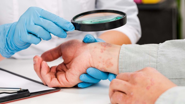 Tratamentul psoriazisului ar putea fi optimizat, arată studiile pe animale