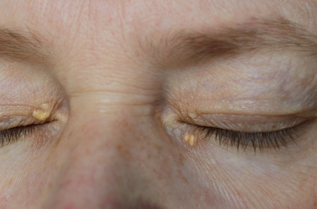 Depozitele de colesterol în zona ochilor: cauze, simptome, tratament