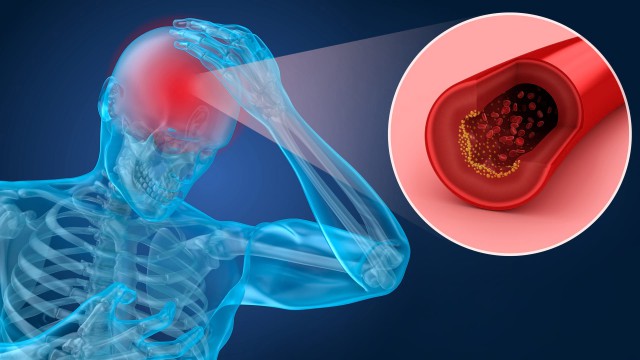 Riscul de a avea un al doilea accident vascular cerebral