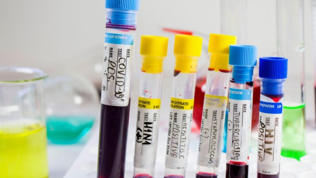 O variantă extrem de virulentă a HIV s-a răspândit în Olanda