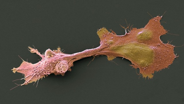 Cum acționează sistemul anti-cancer din celule umane, descoperit de cercetători israelieni