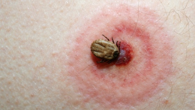 Peste 14% din populaţia mondială a avut boala Lyme