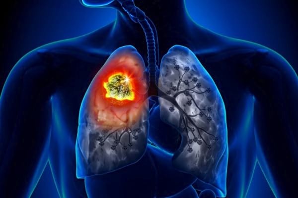 BioNTech şi Regeneron şi-au extins activitatea asupra unui medicament pentru cancerul pulmonar