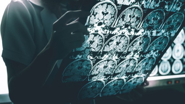 Descoperire uluitoare: Virusul care contribuie la apariţia bolii Alzheimer