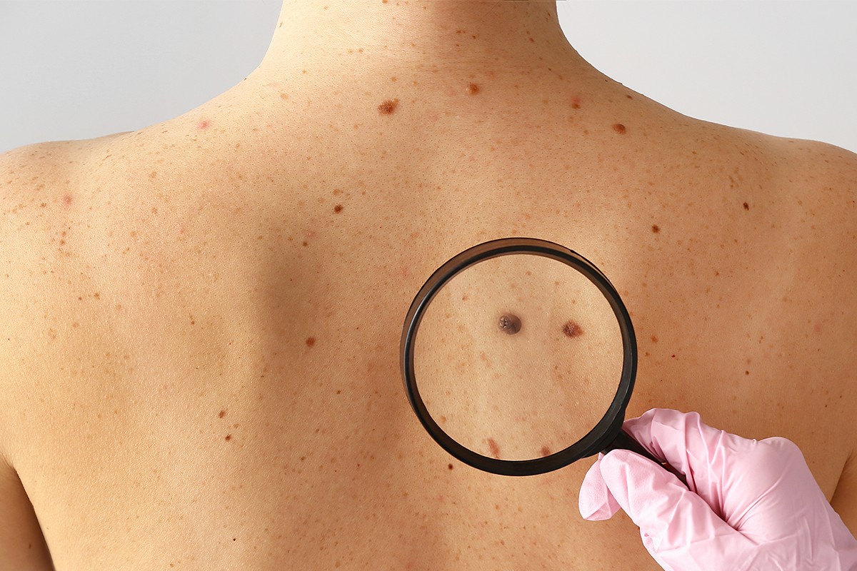 Un medicament care tratează cancerul de piele în formă avansată a fost aprobat în SUA