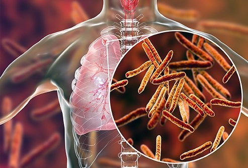 OMS: Cheltuielile globale consacrate luptei împotriva tuberculozei sunt insuficiente