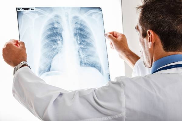 Studiu: De ce nefumătorii fac cancer pulmonar