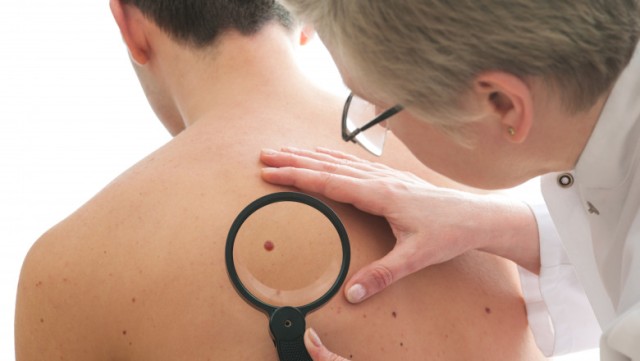 Aluniță sau cancer de piele? Care sunt semnele că trebuie să mergeți la medic