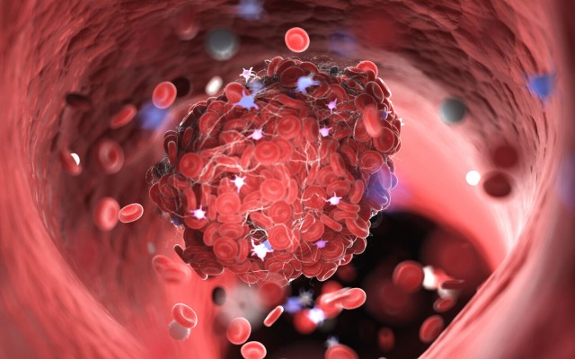 Studiu: Maladia COVID creşte riscul de cheaguri sangvine în primele şase luni după infectare