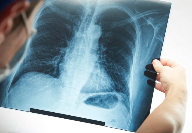 Studiu: 55% din românii morți de cancere pulmonare locuiau în orașe extrem de poluate