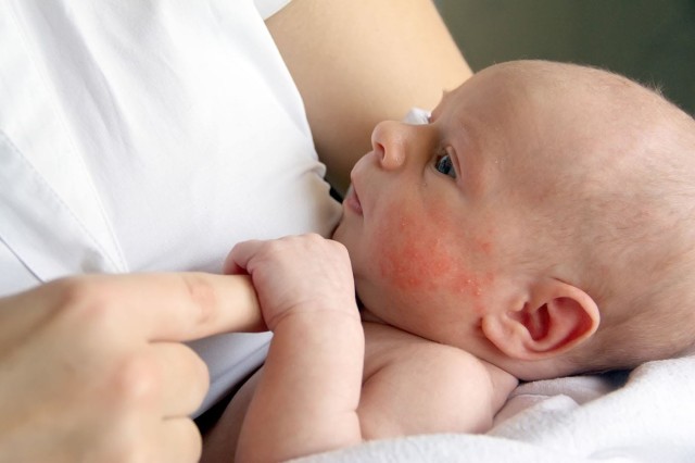 Totul despre vitamina D si eczemele la copii